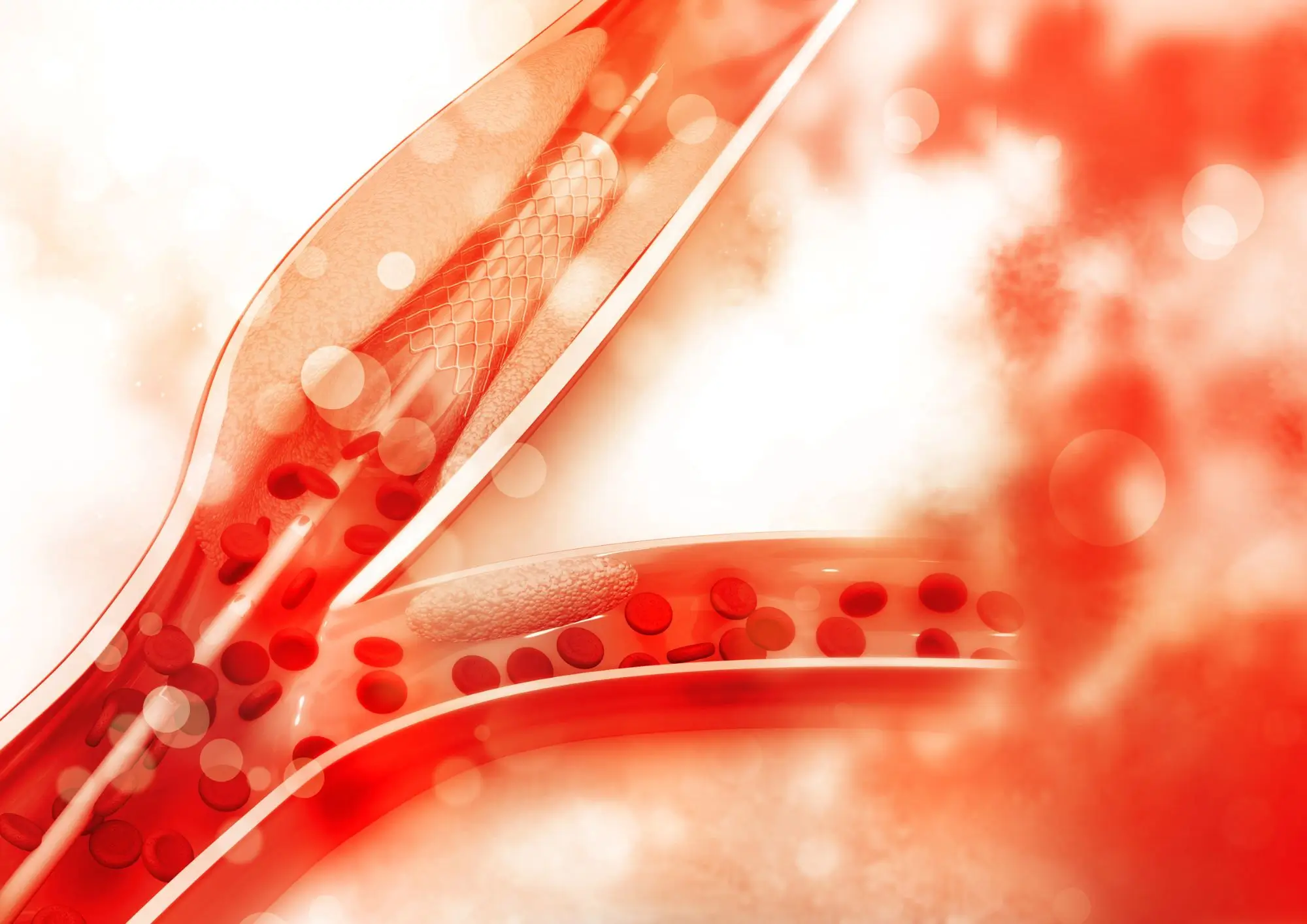 Angioplastyka naczyń tętniczych prącia - małoinwazyjne leczenie zaburzeń erekcji na tle naczyniopochodnym