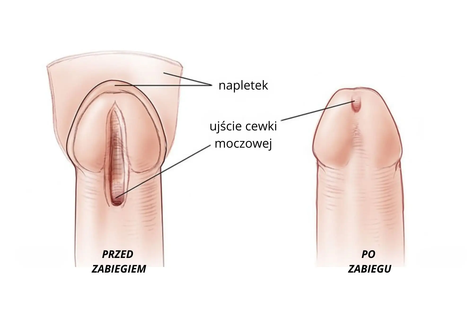 Denerwacja jądra to szansa na zachowanie jądra i uniknięcie orchidektomii, czyli całkowitego usunięcia jądra.
