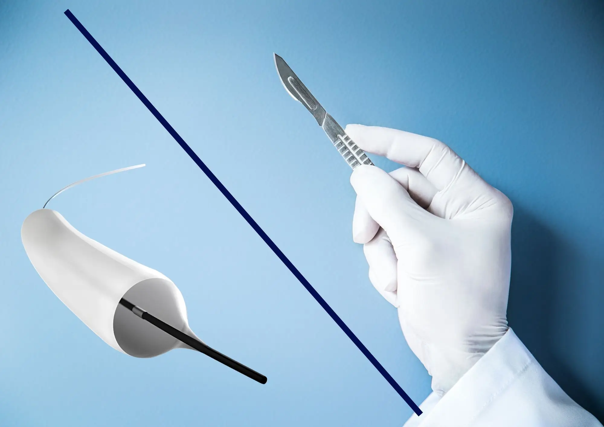 scalpel vs Optilume Która metoda jest najskuteczniejsza w przypadku nawrotowych lub rozległych zwężeń cewki moczowej?