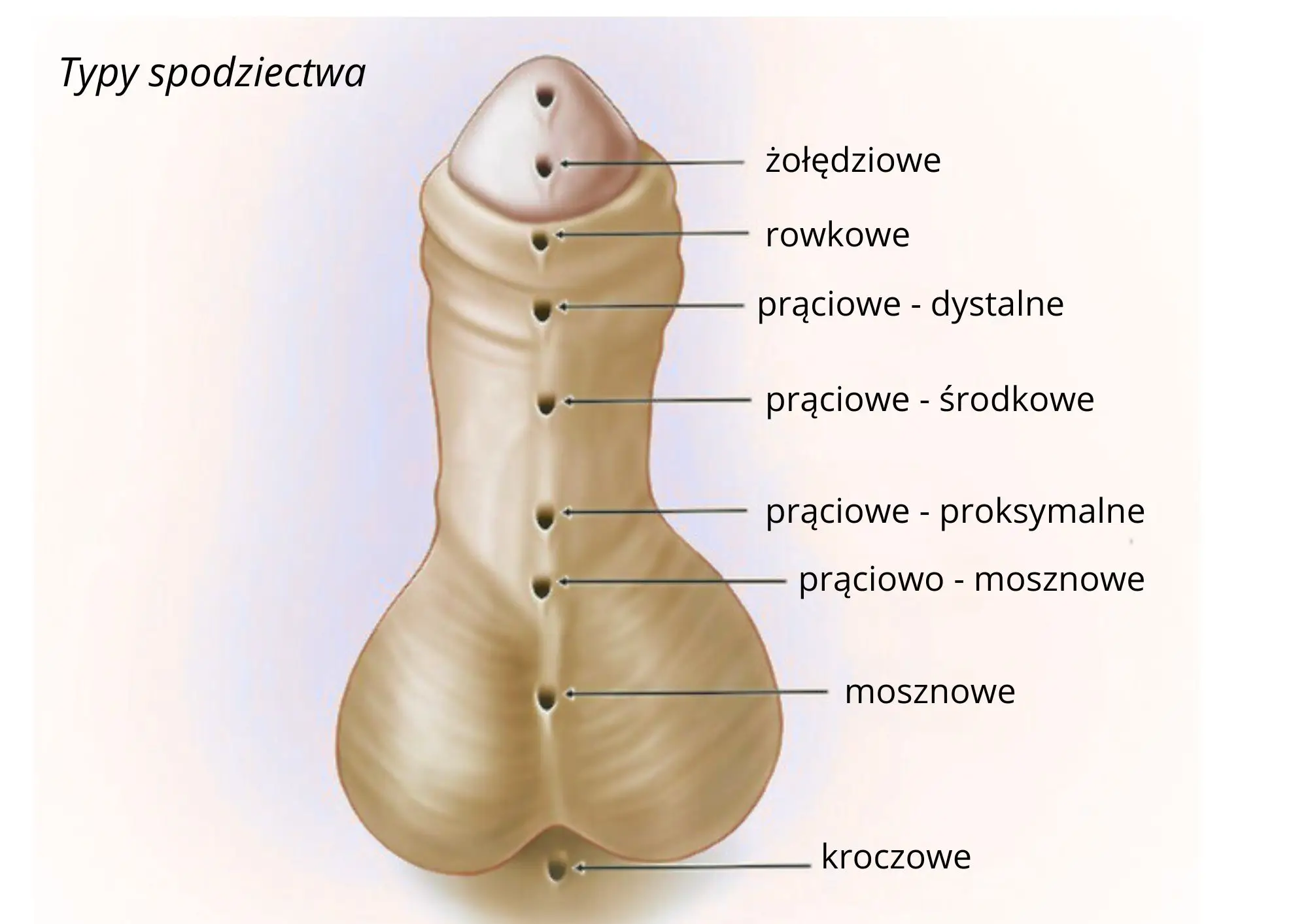typy spodziectwa Spodziectwo u dorosłego mężczyzny - od diagnozy do pełnego powrotu do zdrowia