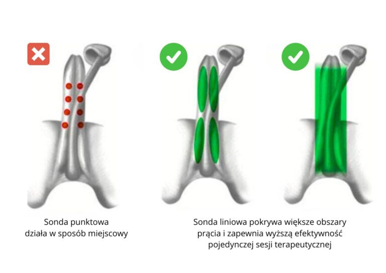 Terapia falą uderzeniową (LI-ESWT/ESWT) 