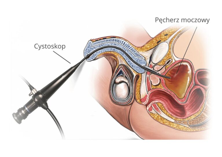 Cystoskopia u mężczyzny Cystoskopia (uretrocystoskopia) – precyzyjna diagnostyka męskiej i żeńskiej cewki moczowej oraz pęcherza