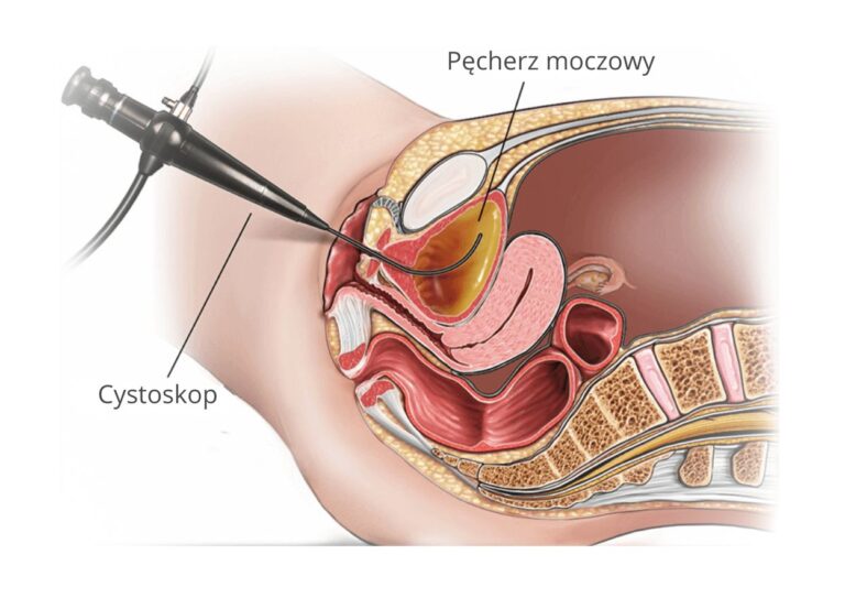Cystoskopia u kobiety Cystoskopia (uretrocystoskopia) – precyzyjna diagnostyka męskiej i żeńskiej cewki moczowej oraz pęcherza