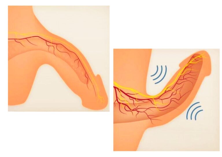 Fala uderzeniowa w leczeniu zaburzeń erekcji 
