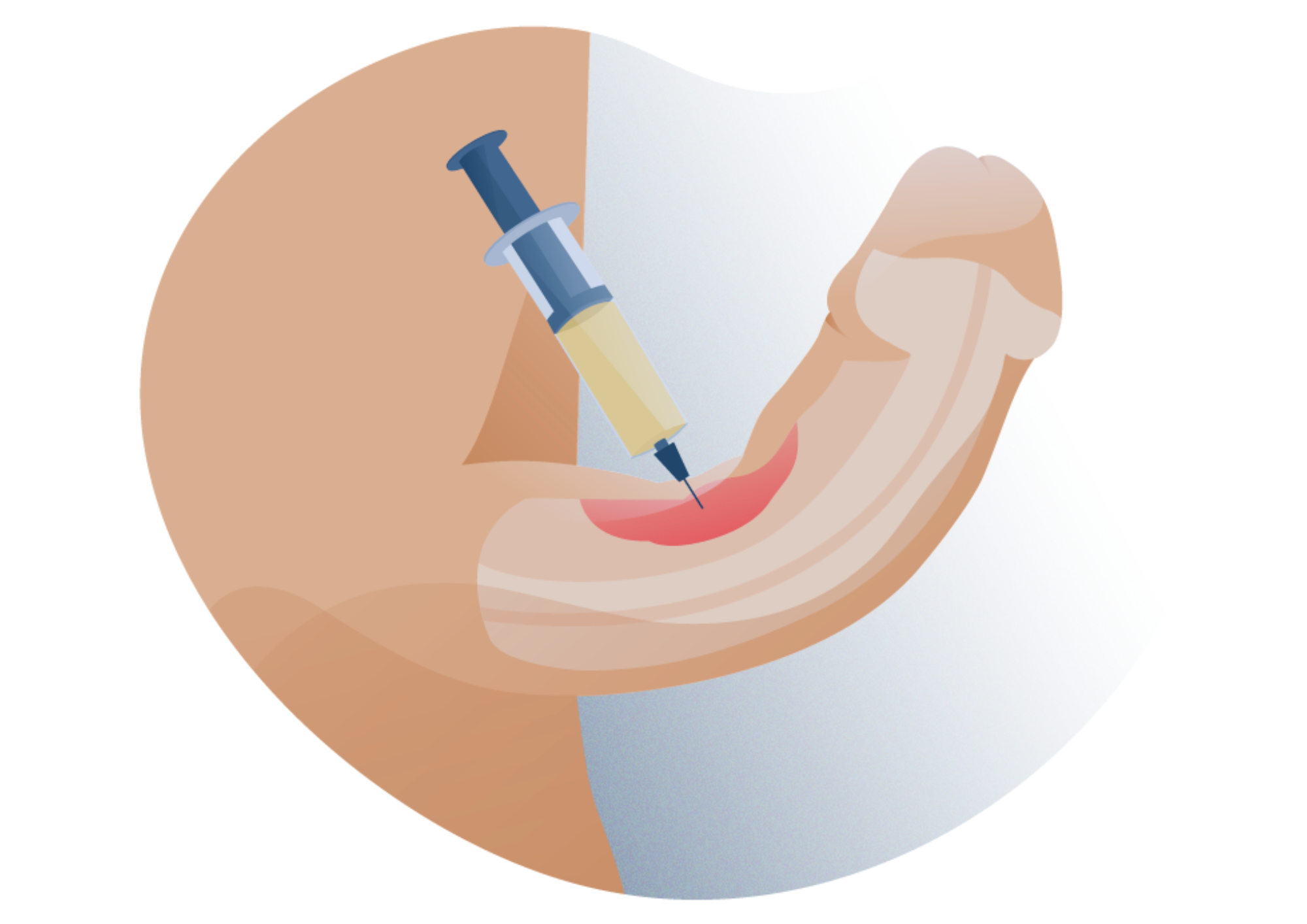 Terapia falą uderzeniową (ESWT) w leczeniu nabytego skrzywienia prącia (choroby Peyronie) wg aktualnych metod klinicznych