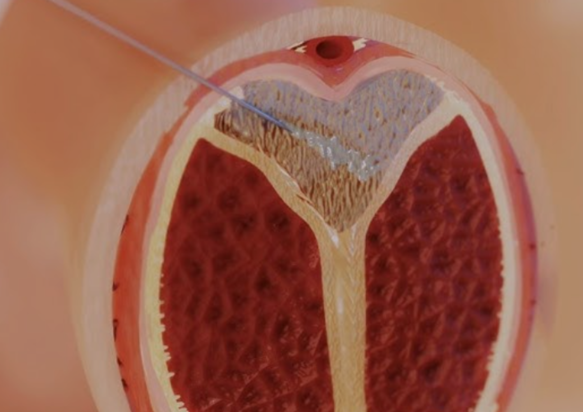 Terapia falą uderzeniową (ESWT) w leczeniu nabytego skrzywienia prącia (choroby Peyronie) wg aktualnych metod klinicznych