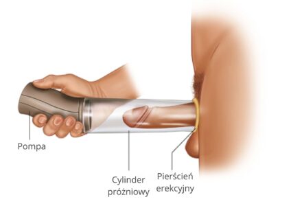 pompa próżniowa w leczeniu zaburzeń erekcji
